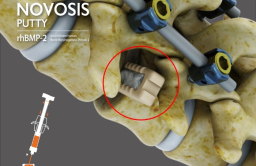 CGBio gets FDA approval for Novosis Putty