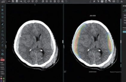 JLK gets OK from FDA for ICH diagnosis solution